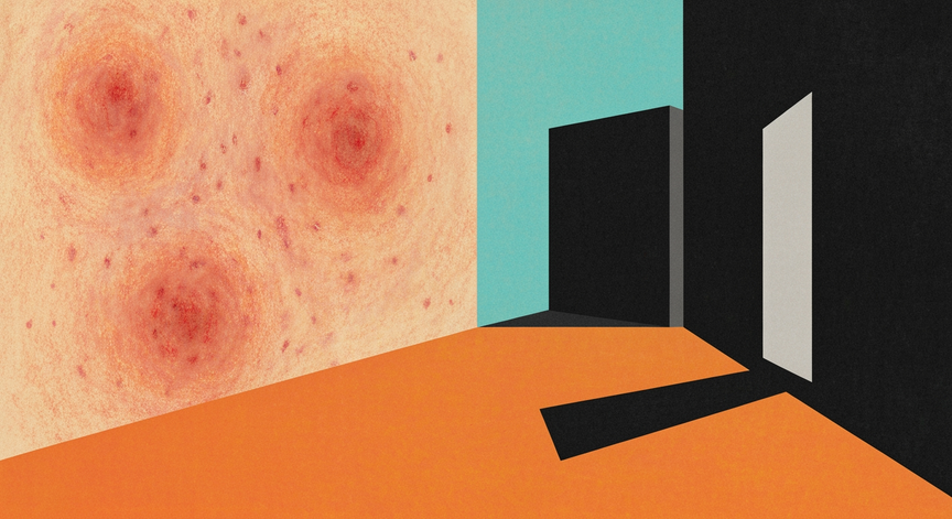 Eczema Causes Explained