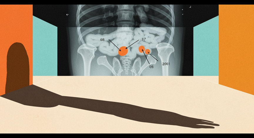 Radiography in Crohn's Disease