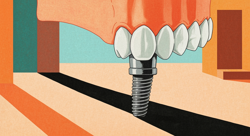 Dental Implants Explained