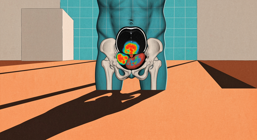 PET Scans in Advanced Prostate Cancer Care