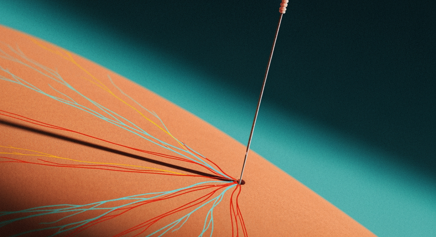 Acupuncture for Athletic Recovery and Hormones