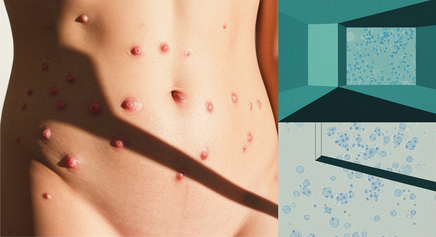 Lymphomatoid Papulosis Management